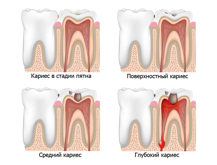 Как происходит разрушение зубов