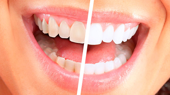 Отбеливание зубов: польза или вред?